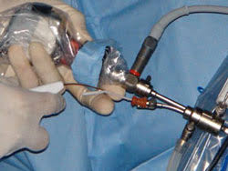 Ce geste est effectué sous anesthésie générale et dure environ 15 minutes. Cabinet Gynecologie Ste Maxime Ligature Des Trompes