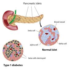 Type 1 Diabetes Medlineplus Genetics