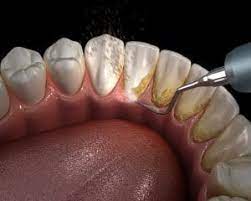 Toothpaste that gives you a healthy smile, with specialized solutions tailored to you. Newhall Dentist Explains Why You Shouldn T Skip Your Next Cleaning Newhall Ca