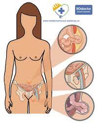 We did not find results for: Medicina Interna Hernia Abdominala Tipuri Cauze Si Simptome Rodoctor Medical Center