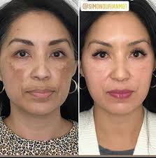 Image result for Melasma