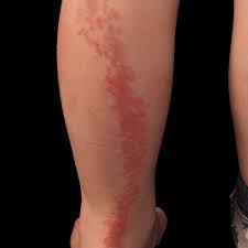 Image result for Linear Dermatitis