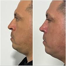Dr. Rene Pacheco ORL/CIRUJANO PLASTICO FACIAL Post quirúrgico un mes de  evolución, Rinoplastia masculina. Resultados naturales, manteniendo líneas  estéticas armónicas y adecuadas. Turnos para video llamada o presenciales  al los números: 0995090978. #