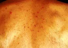 Structure can be projected onto data already in storage. 8 Ways The Coronavirus Can Affect Your Skin From Covid Toes Menafn Com