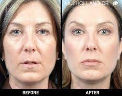 Generally speaking, your doctor will charge between $800 and $1,500 per syringe. Restylane Injectable Toronto See Restylane Before Afters