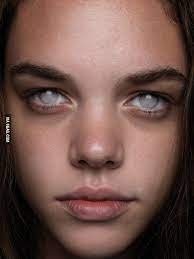 This Is What Blind Eyes Look Like Mostly When Cause Is Not Injury Eye Photography Blind Girl Face