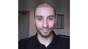 Personalized services for all types of hair loss. I Went To Turkey For A Hair Transplant Bbc Three