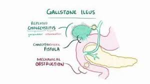Image result for Gallstone