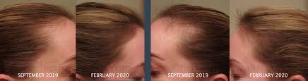 Artas robotic hair transplantation of the 1500 fu (about 3000 hair). Before After Photos