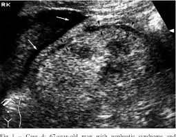 Fever can indicate infectious inflammatory affection of the kidneys and the urinary ducts, or can be the sign of the main disease. Perirenal Fluid In Renal Parenchymal Medical Disease Floating Kidney Clinical Significance And Sonographic Grading Semantic Scholar