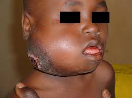 Treatment options include chemotherapy, radiation therapy (radiotherapy) and monoclonal antibodies. Non Hodgkin Lymphomas Amboss