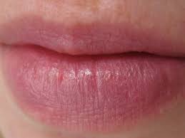 Sources reviewed by nivin todd, md on december 17, 2020. Mild Herpes Photos The Hsv Blog