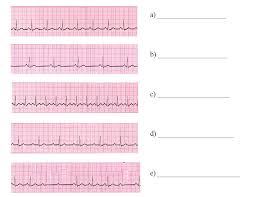 Furthermore, bradycardia itself may prolong the qt interval.1 2 it's possible that leaving patients in a severely bradycardic state may. Solved Look At The 5 Ecg Traces Below And Label Each From Chegg Com