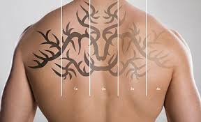 However, you will get a sore by all the rubbing so be prepared. 1 Rated Laser Tattoo Removal Toronto Easily Remove Unwanted Tattoos Black Line Studio Black Line Studios