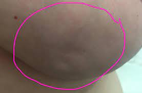 Women with inflammatory breast cancer can develop a red, pink, or purple rash across part of their breast. This Is What My Breast Cancer Looks Like Woman S Facebook Photo Of Symptoms Goes Viral