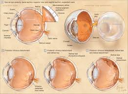 Over time, this can cause the retina to. Normal Eye Anatomy Pvd Retinal Tear And Retinal Detachment Download Scientific Diagram