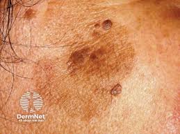 Image result for Solar Lentigo