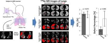 Cystic fibrosis (cf) is a genetic disease that affects your lungs, pancreas, and other organs. Hyperpolarized 129xe For Investigation Of Mild Cystic Fibrosis Lung Disease In Pediatric Patients Journal Of Cystic Fibrosis