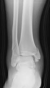 Image result for Ankle XRay