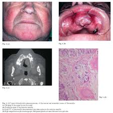 Who is most likely to get bone cancer? Metastatic Tumors To The Jaws A Report Of Eight New Cases