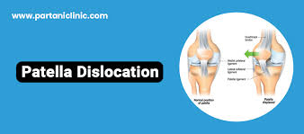 Image result for Patellar Dislocation