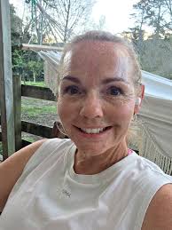 Knee swelling after running with no pain?