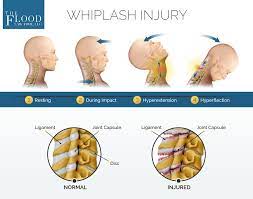 Whiplash after a car accident is an injury to a person's neck muscles and ligaments. Whiplash Injury Froma Car Accident Connecticut Injury Attorney