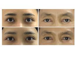 Official Newsletter of Asia Pacific Society of Ophthalmic Plastic &  Reconstructive Surgery