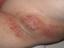 Image result for scabies in the groin area