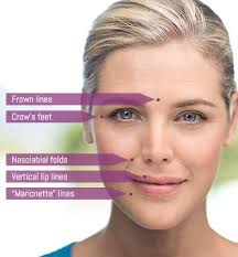 Juvéderm® filler treatments are temporary and so you will need retreatment. Fillers Medical Aesthetics Of Chattanooga