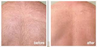 The biggest factor is the. Laser Hair Removal Pain Free Derma Health Institute