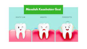 Peradangan ini dapat menyebabkan lidah bengkak, terasa lunak, dan mengalami perubahan warna termasuk lidah berwarna putih 7. Masalah Kesehatan Gusi Sakit Bengkak Dan Pendarahan Gusi
