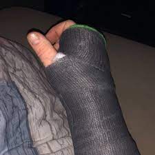 Distale Radiusfraktur Wie Viele Gipswechsel Gesundheit Und Medizin Gipsarm Arm Gebrochen