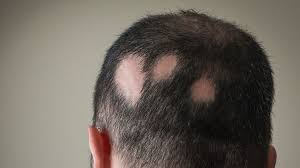 Glatzen simulator als hilfe bei haarausfall? Haarausfall Stoppen So Beugst Du Einer Glatze Vor Men S Health