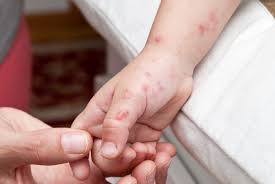 Sympthom bintik merah di badan. Impetigo Gejala Penyebab Dan Mengobati Alodokter