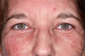 Image result for Angioedema