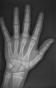 Image result for Hand Growth Plates