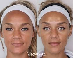 Eyebrow threadlift