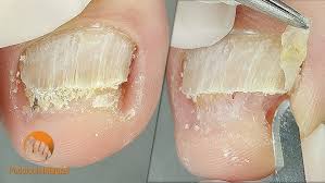 Image result for Onychogryphosis feet