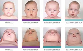 Image result for Positional Head Deformity