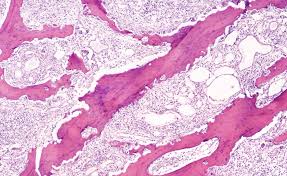 Image result for Osteomyelitis