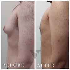 Image result for Gynecomastia