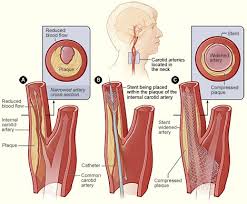 Carotid artery disease is a disease in which a waxy substance called plaque builds up inside the carotid arteries of the neck. Carotid Stenting Wikipedia