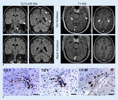 Empty sella syndrom following pituitary. Clippers Syndrom Mit Supratentorieller Und Spinaler Beteiligung Und Histologischen Besonderheiten Springerlink