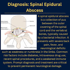 Image result for Spinal Epidural Abscess