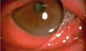 2 Parinaud S Oculoglandular Syndrome In A Patient With Mediterranean Download Scientific Diagram