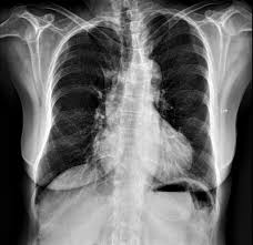 Check spelling or type a new query. Pectus Carinatum Radiology Case Radiopaedia Org