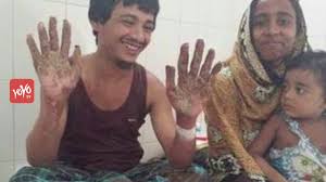 The topic tree man syndrome you are seeking is a synonym, or alternative name, or is closely related to the medical condition epidermodysplasia verruciformis. Tree Man Of Bangladesh Cured After Undergoing 16 Surgeries Yoyo Tv English Youtube