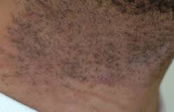 When the molecules are exploded after the first laser treatment, that is the second exposure and you are having an allergic reaction to it. Laser Hair Removal For Razor Bumps