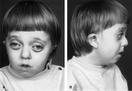 Patient 1 with Crouzon's syndrome, who previously underwent surgical... |  Download Scientific Diagram